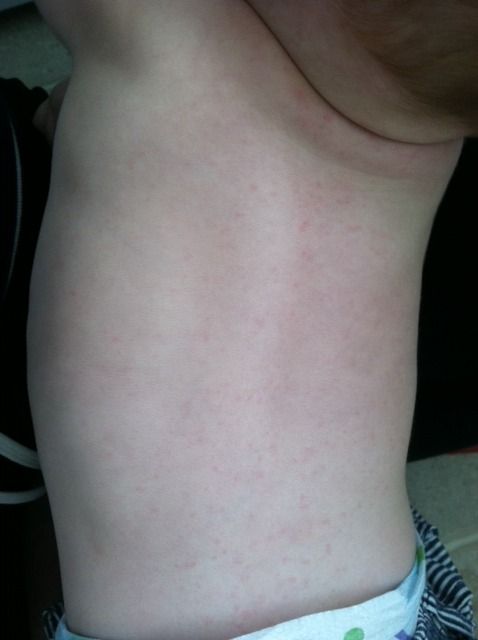 Rash Help Pic Included Babycenter